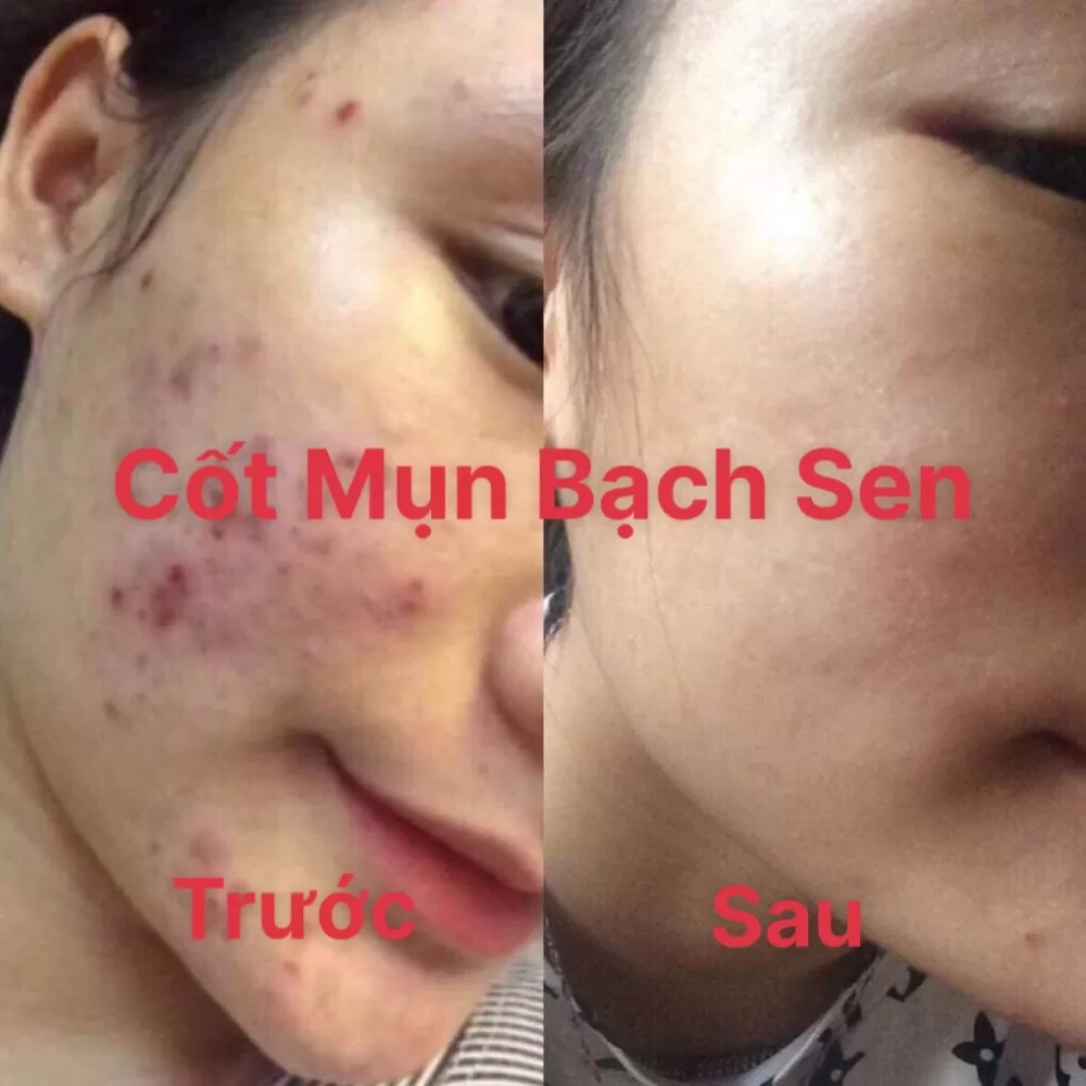 Trước và sau khi dùng cốt mụn bạch sen Đan Thy Trước và sau khi dùng cốt mụn bạch sen Đan Thy