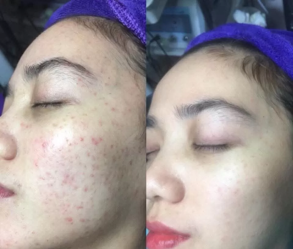 Làn da giảm mụn rõ rệt sau khi xài cốt mụn bạch sen đan thy Làn da giảm mụn rõ rệt sau khi xài cốt mụn bạch sen đan thy